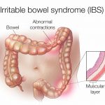 9 tünet, ami arra utal, hogy te is IBS-ben szenvedsz